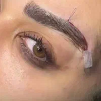 جراحی پلک 8 دایرکت ابرو 8 ساکشن غبغب 10 اتوپلاستی
