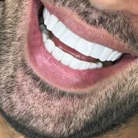 کامپوزیت دندان تخفیف ویژه باور نکردنی