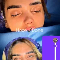 جراحی بینی با قیمت شگفت انگیز ۳۱ میلیون