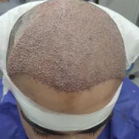 کاشت مو به روش شیرازی|خدمات آرایشگری و زیبایی|قم, زنبیل آباد|دیوار