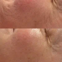 هایفو/لیفت پوست/کانتورینگ صورت/رفع غبغب|خدمات آرایشگری و زیبایی|مسجد سلیمان, |دیوار