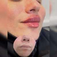 جشنواره تخفیفی ژل و بوتاکس