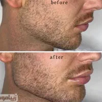 جشنواره ی پاییزه ژل ،بوتاکس،مزو|خدمات آرایشگری و زیبایی|شاهین‌شهر, فردوسی|دیوار