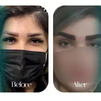 کاشت مو و ابرو آذرشهر ،میانه، ملکان ،تبریز