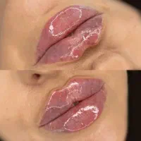 آموزش ژل و بوتاکس ‌فیلر بادی نخ و‌مزو و مزو ژل