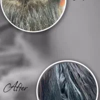 درمان قطعی شپش