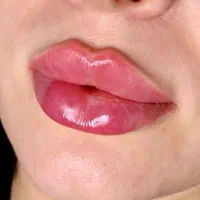 تخفیفات ۵۰٪ ژل و بوتاکس وفیلر دکتر زیبایی اقساط