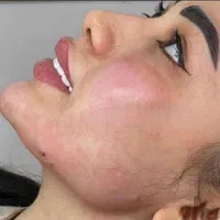 تزریق ژل لب و گونه و چانه.. (جشنواره)درمطب فقط499ت|خدمات آرایشگری و زیبایی|اصفهان, باغ زیار|دیوار