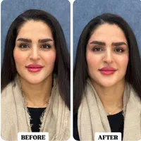 فیلر بادی ژل لب بوتاکس نخ لیفت فیلر بینی آنزیم لب|خدمات آرایشگری و زیبایی|اصفهان, باغ نگاره|دیوار