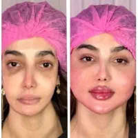 تزریق ژل و فیلر لب،گونه،چانه(جشنواره)درمطب فقط499ت|خدمات آرایشگری و زیبایی|اصفهان, باغ زیار|دیوار