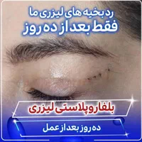 بلفاروپلاستی(جراحی پلک بالا و پایین)توسط چشم پزشک