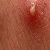 علاج بیماری زگیل تناسلی