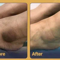 کفسابی و رفع تیرگی قوزک پا تضمینی