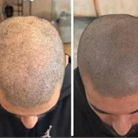 اسکالپ موی سر . بلیدینگ و میکرو پیگمنتیشن|خدمات آرایشگری و زیبایی|تهران, صادقیه|دیوار