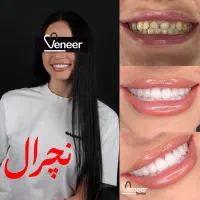 کامپوزیت دندان  با تکنیک لیرینگ  ( فقط در ۱ جلسه)