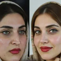 جراحی بینی ، فوق تخصص جراحی پلاستیک