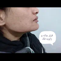 تزریق بوتاکس و ژل در کلینیک(توسط پزشک،)|خدمات آرایشگری و زیبایی|مشهد, هفت تیر (آب و برق)|دیوار