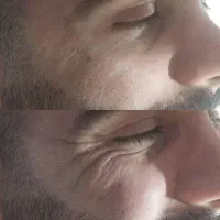 آف ژل و بوتاکس .مزو وآنزیم...|خدمات آرایشگری و زیبایی|ایذه, |دیوار