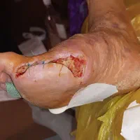 پانسمان نوین زخم بستر / دیابتی / سوختگی / سرطانی|خدمات آرایشگری و زیبایی|ارومیه, |دیوار