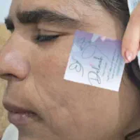 برداشتن لک و کک و مک