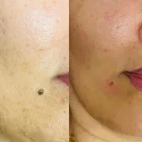 پرسینگ ناخن چال لپ پلاسمامیکرودرمال مرو خال مژه|خدمات آرایشگری و زیبایی|قم, شهرک فاطمیه|دیوار