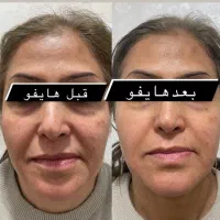 جشنواره  هایفو جوانساز  لیفت پوست|خدمات آرایشگری و زیبایی|اهواز, نادری|دیوار