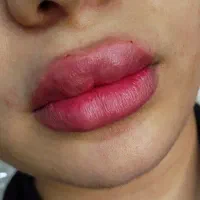 ژل وبوتاکس