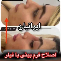 خال،فیلر،بوتاکس،انزیم،تخفیف ۵۰درصدی جشنواره ای|خدمات آرایشگری و زیبایی|کرمانشاه, |دیوار