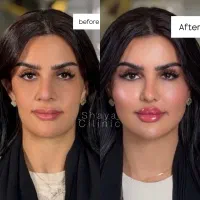 آف آموزش و تزریق فوق تخصصی فیلر بوتاکس(بمدت محدود)