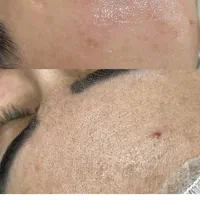 آموزش تخصصی پاکسازی پوست