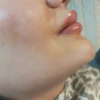 خدمات ژل و بوتاکس