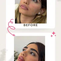 تزریق فیلر و بوتاکس با تخفیف ویژه