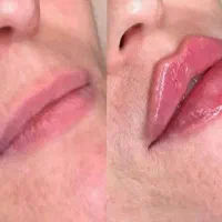 پی آر پی رویش مو۲۴۰۰.فیلرژل۸۵۰بوتاکس۸۰۰