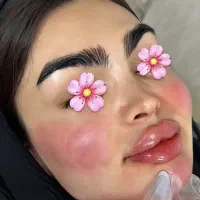 فیلر لب و مادلینگ صورت و بوتاکس