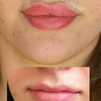 لیزر، ژل،بوتاکس،خال برداری و الکترولیز،لیبیاپلاستی|خدمات آرایشگری و زیبایی|شیراز, پانصد دستگاه ارتش|دیوار