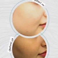 درمان پوست و ریمو تتو