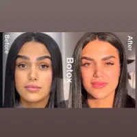 مدل بوتاکس،فیلر صورت و بدن ،مزوتراپی،prp