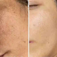 هایفوتراپی لیزر پاکسازی پلاژن روشن سازی فیشیال|خدمات آرایشگری و زیبایی|شیراز, ریاستی|دیوار