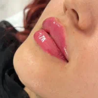 تزریق ژل و بوتاکس در کلینیک زیبایی|خدمات آرایشگری و زیبایی|کرمانشاه, |دیوار