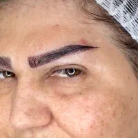 «کاشت ابرو طبیعی در بوشهر تیم پزشکی مجرب