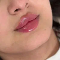 تخفیفات ۵۰ درصدی ژل و بوتاکس فیلر