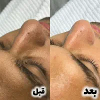 فیشال تخصصی / مزونیدلینگ پوست بانوان و آقایان
