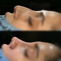 تخفیف عمل بینی لیفت رفع غبغب لیپو ابدو دایرکت ابرو|خدمات آرایشگری و زیبایی|قم, شاه ابراهیم|دیوار