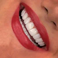 دندانپزشکی اقساط لمینت*ایمپلنت*دندان مصنوعی|خدمات آرایشگری و زیبایی|اصفهان, سودان|دیوار
