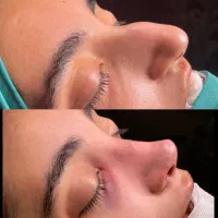 عمل/بینی/ جراحی زیبایی/بدون تامپون/اقساطی