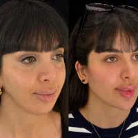 ژل بوتاکس150کلینیک پوست آموزش نخ ژل هایفو|خدمات آرایشگری و زیبایی|تهران, زعفرانیه|دیوار