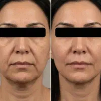 جدیدترین متد جوانسازی دنیا