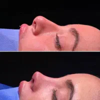 عمل بینی و لیفت اندسکوپی فقط ۲۵ میلیون