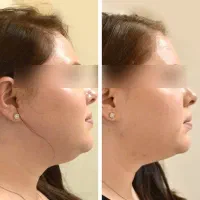 لاغری و جوانسازی با دستگاه هایفو(زیبایی و پزشکی)