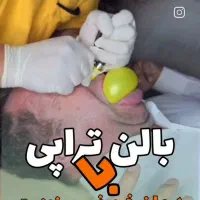 بالن تراپی جهت سینوزیت و رفع خرپف در خواب